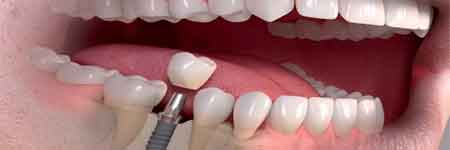 DENTAL VACATIONS - Health Tourism Division of Smile Centre India photo 1